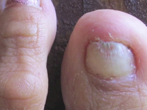 Ripening of nails, ringworm