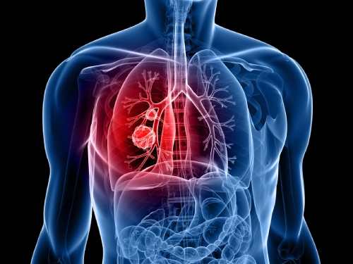 Respiratory diseases