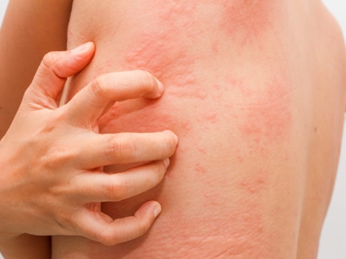 Treatment of all kinds of skin and allergy diseases